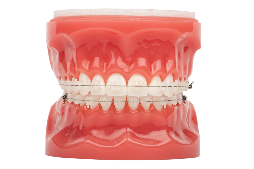 Dental model showing clear ceramic brackets on upper and lower teeth